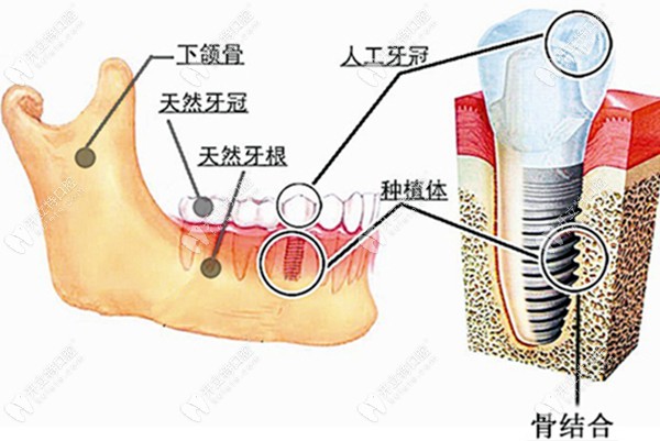 种植牙在牙骨内的图