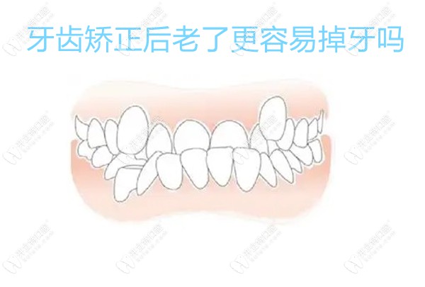牙齿矫正后老了更容易掉牙吗?一般30/40/45岁整牙都不会,除非.