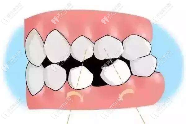 牙齿松动导致牙齿歪斜