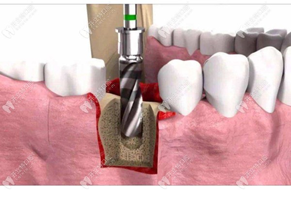 种植牙的植入过程
