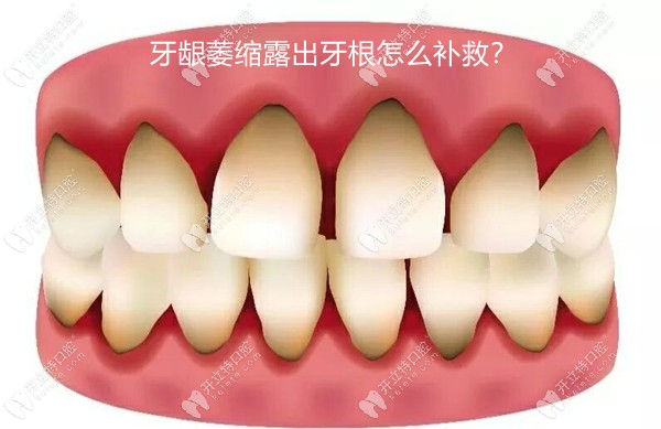 牙龈萎缩露出牙根怎么补救？据说维生素c能让牙龈再生