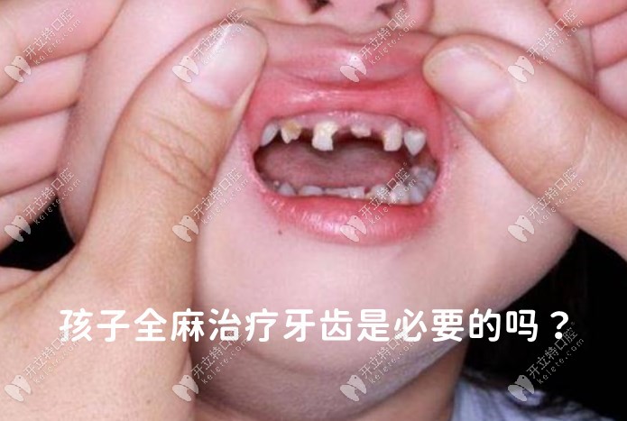 小孩全麻补牙有必要吗？以我给孩子全麻治疗牙齿经历说下
