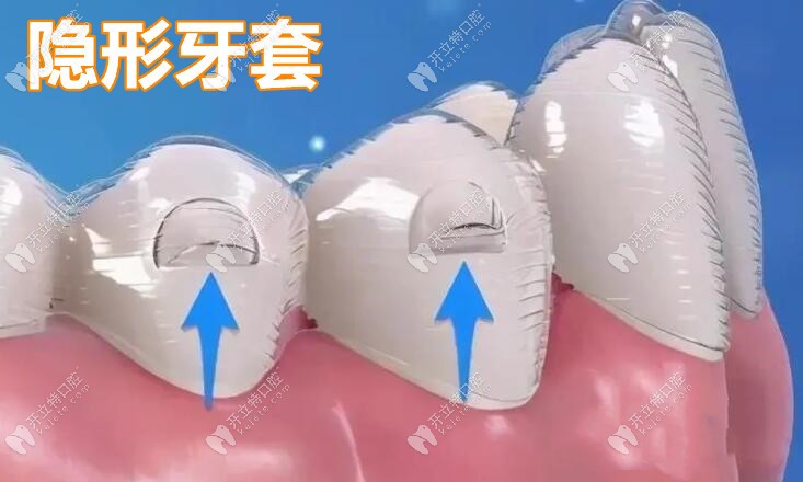 長沙齒馨口腔隱形牙套
