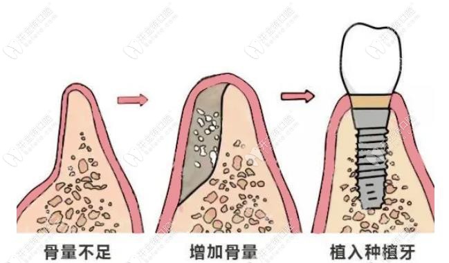 种植牙植骨和不植骨的区别:了解植骨种植牙的利弊就可区分