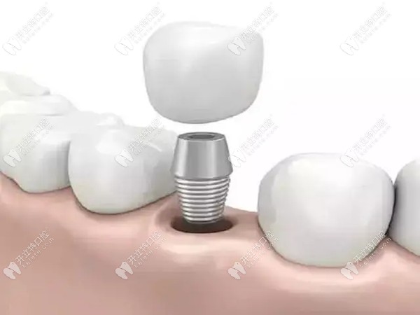 广州私立牙科种植牙价格m.kelete.com