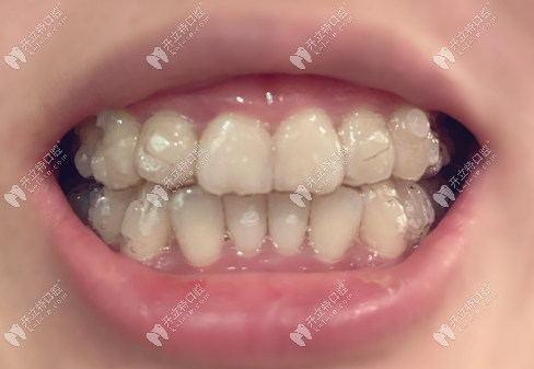 牙性和骨性嘴凸怎么判断