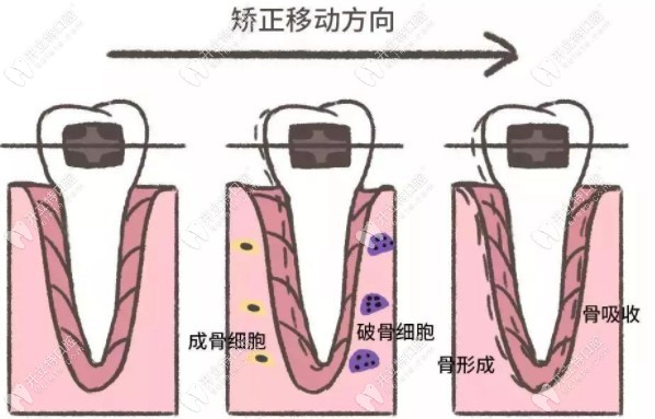 牙齿矫正原理