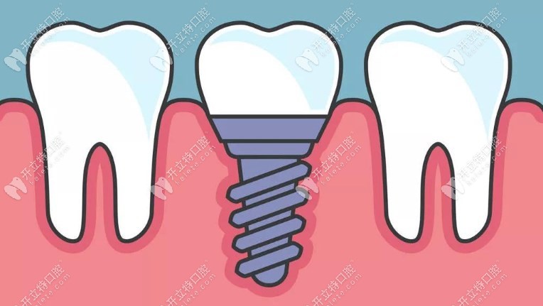 诚之康口腔种植牙多少钱
