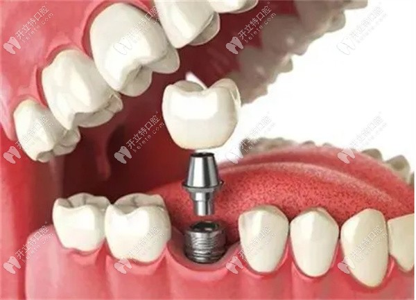 人工种植牙能用多少年