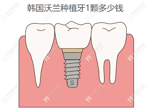 韩国沃兰种植牙1颗多少钱www.kelete.com