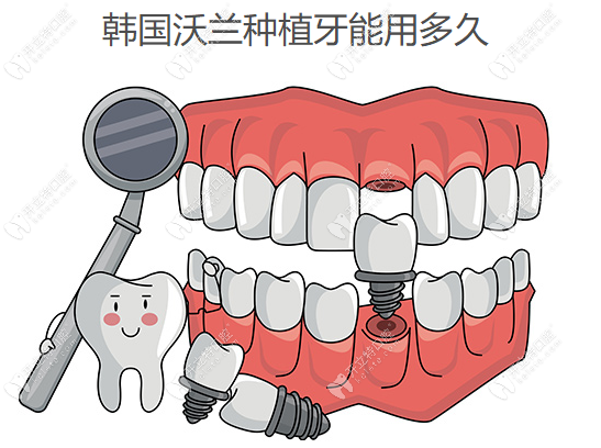 韓國沃蘭種植牙能用多久