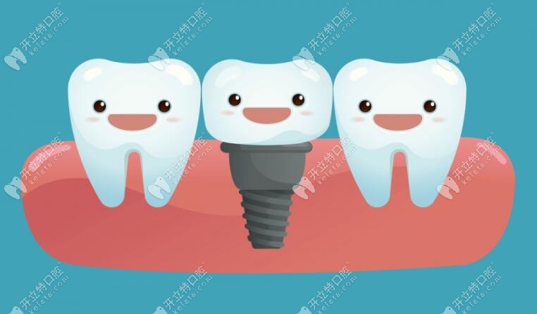 独立种植牙技术www.kelete.com