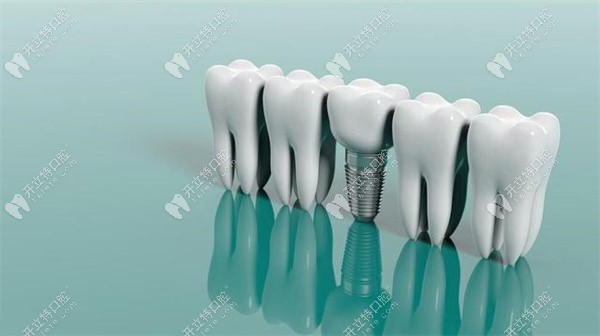 种植牙的流程和时间是多久?种植牙流程需要5次时间在3-4个月