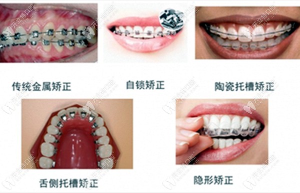 牙齿矫正器的类型