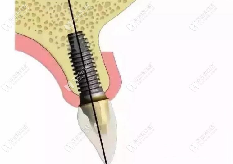 门牙种植的全部过程:从视频看主要分为安装植体基台和牙冠