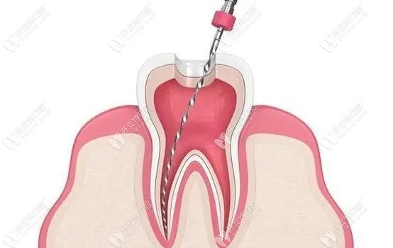 做完根管治疗多久可以矫正牙齿