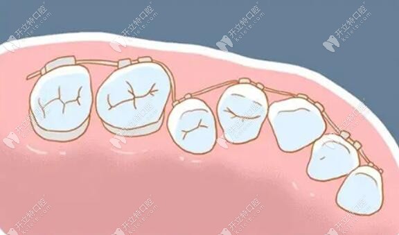 牙齿矫正过程变化图www.kelete.com