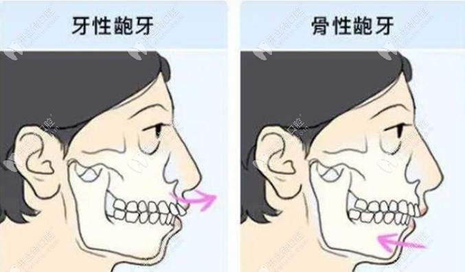 牙性龅牙、骨性龅牙对比图