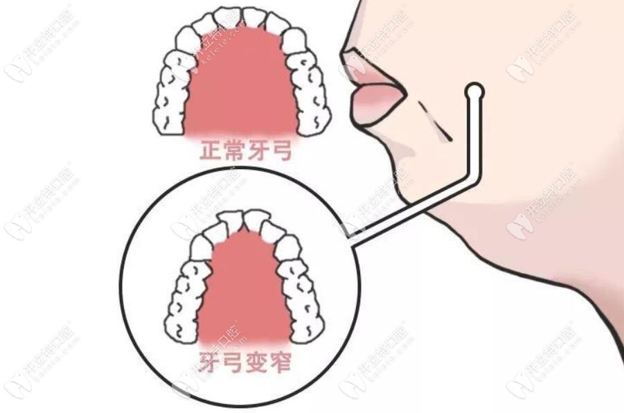 牙弓变窄怎么办