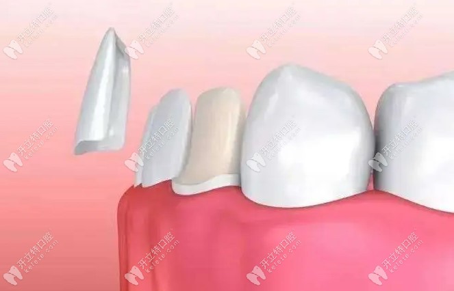 合肥牙齿贴面多少钱一颗?正规好的牙科做牙齿瓷贴面需2500起