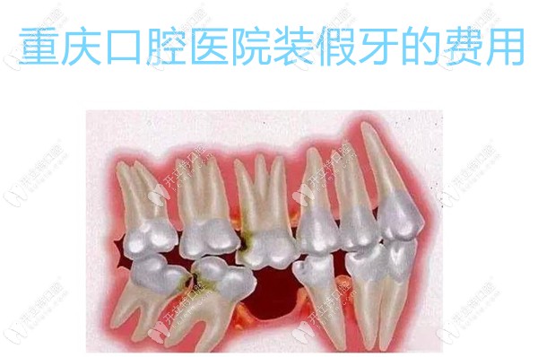 重庆口腔医院装假牙的费用:大概500-8800起一颗,1万多可做半口