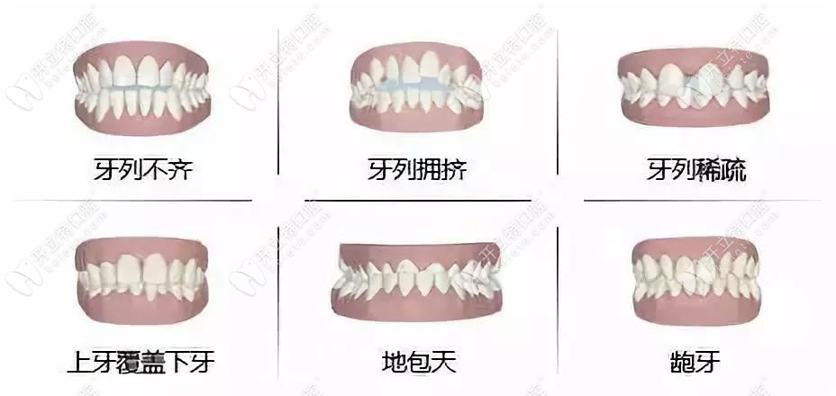 国产爱舒笑隐形矫正是可信赖的吗