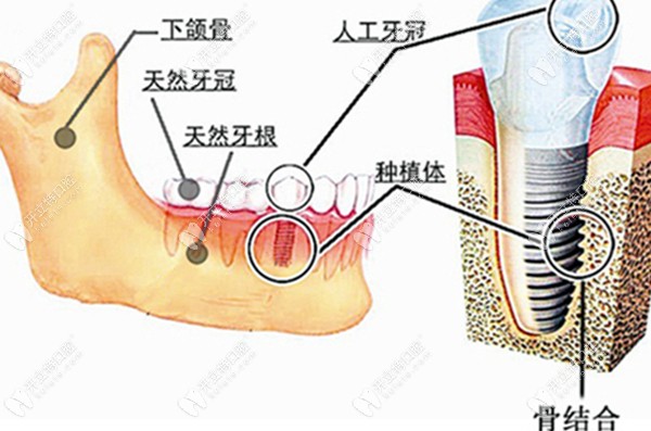 种植牙与天然牙的对比www.kelete.com