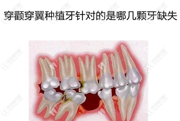 穿颧穿翼种植牙针对的是哪几颗牙缺失