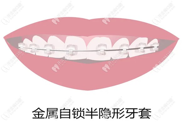 先说下半隐形牙套的优点和缺点,再对比和钢丝牙套的区别