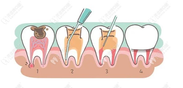 做完根管治疗一定要做牙套吗?做牙套防止牙劈裂/不做寿命短