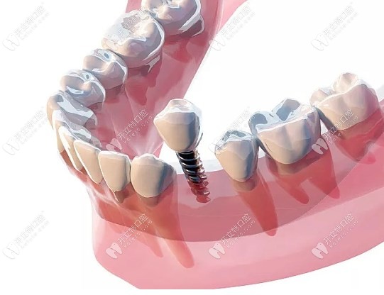 如果种植牙过了20年坏了怎么办?可考虑修复/更换种植牙/镶牙