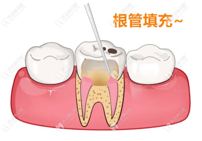 根管做完了不想做牙冠m.kelete.com