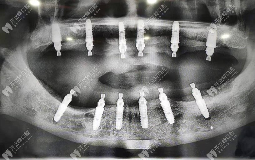 全口种植牙CT图片