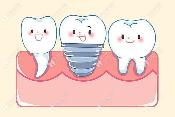 西安雁塔區(qū)半口種植牙價格