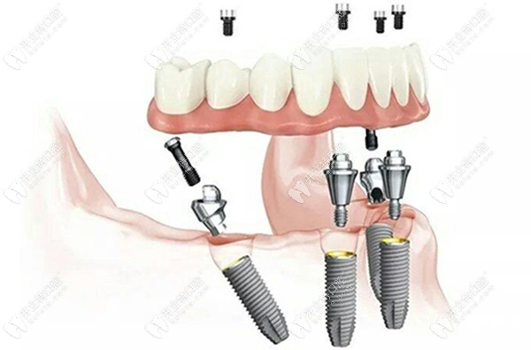 西安雁塔區(qū)全口種植牙價格