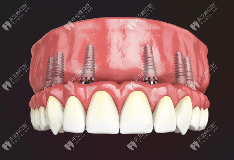 满口种植牙要多少钱