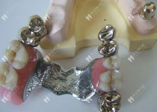 钴铬合金托树脂牙全口需要多少钱?满口活动义齿价格在2000+