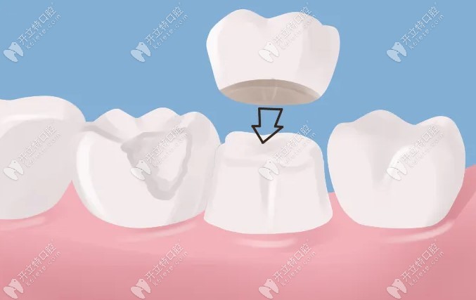 合肥口腔医院做牙冠多少钱一颗?全瓷牙套收费在1200-6800元起