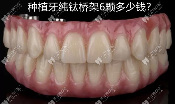 种植牙纯钛桥架6颗多少钱?get成都/南京/杭州种植牙纯钛价格