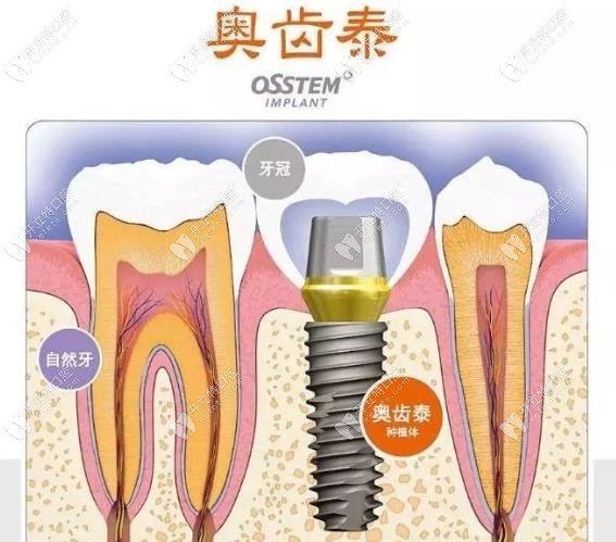 韩国奥齿泰进口种植牙怎么样