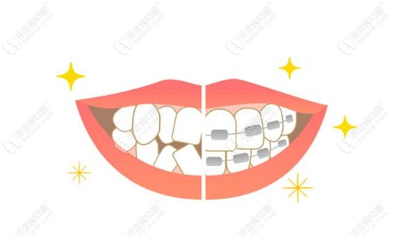 成都德康口腔矯正牙齒優(yōu)勢kelete.com