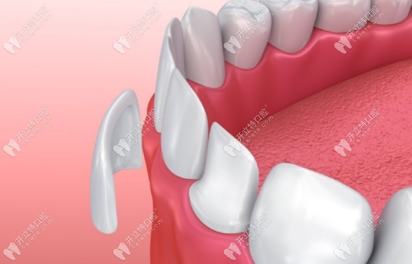 牙齿贴面和全瓷牙的区别