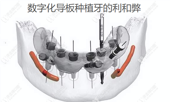 數(shù)字化導板種植牙的利和弊