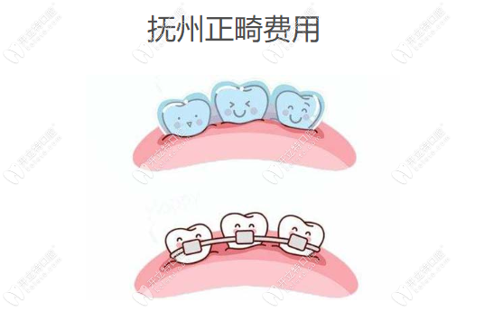 撫州正畸費用
