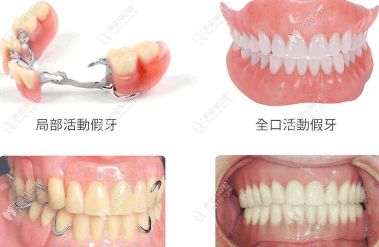 耒陽牙牙樂口腔假牙組合