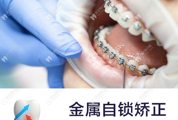 耒陽牙牙樂口腔金屬自鎖矯正