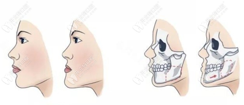 正颌手术过程图解