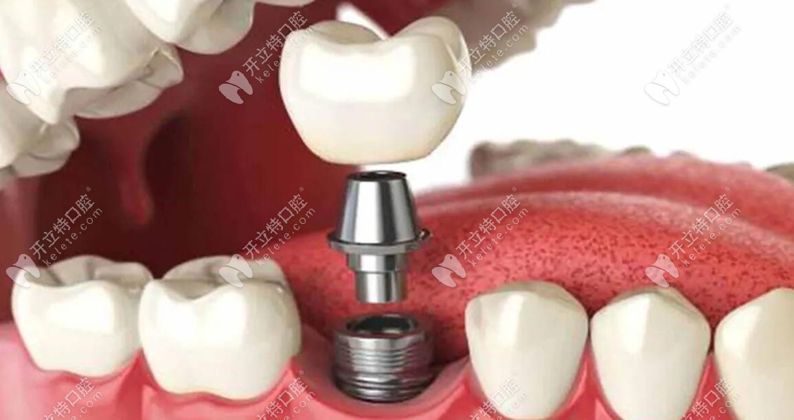 诺贝尔pmc种植牙牙槽骨骨量不够需要植骨或有口腔疾病需要治疗