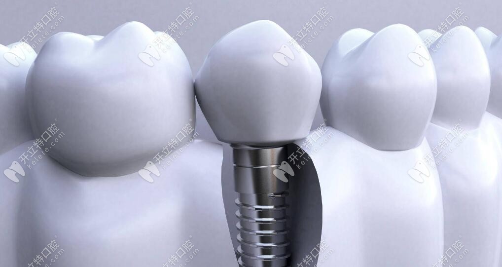 诺贝尔pmc种植牙牙槽骨状况好、没有口腔疾病的情况