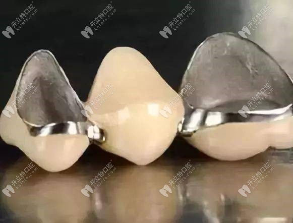 纯钛金属牙冠示意图